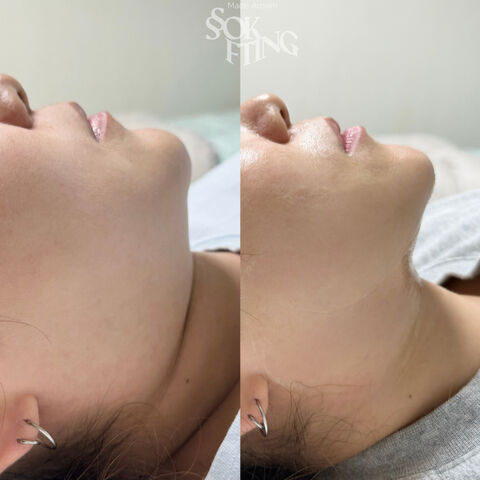 [성북] 단독특가! 신경쓰이는 팔뚝/승모/턱라인 1회만 받아도 보이는 효과 상품 이미지